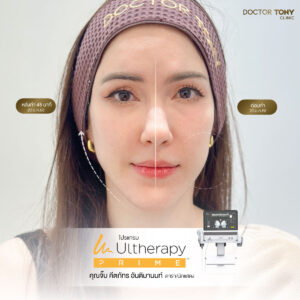 รีวิว ulthera prime 2