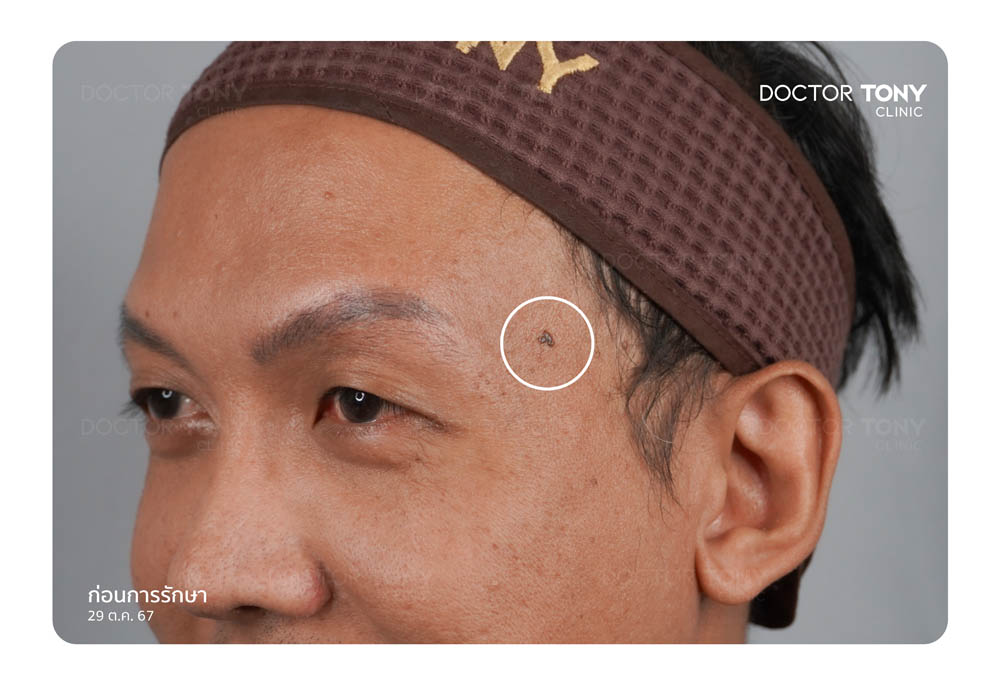 กำจัดไฝ ติ่งเนื้อ co2 laser