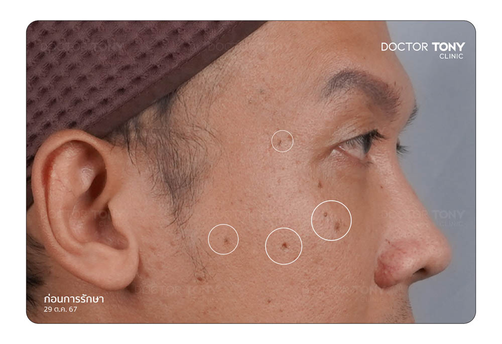 ก่อนทำ co2 laser 1
