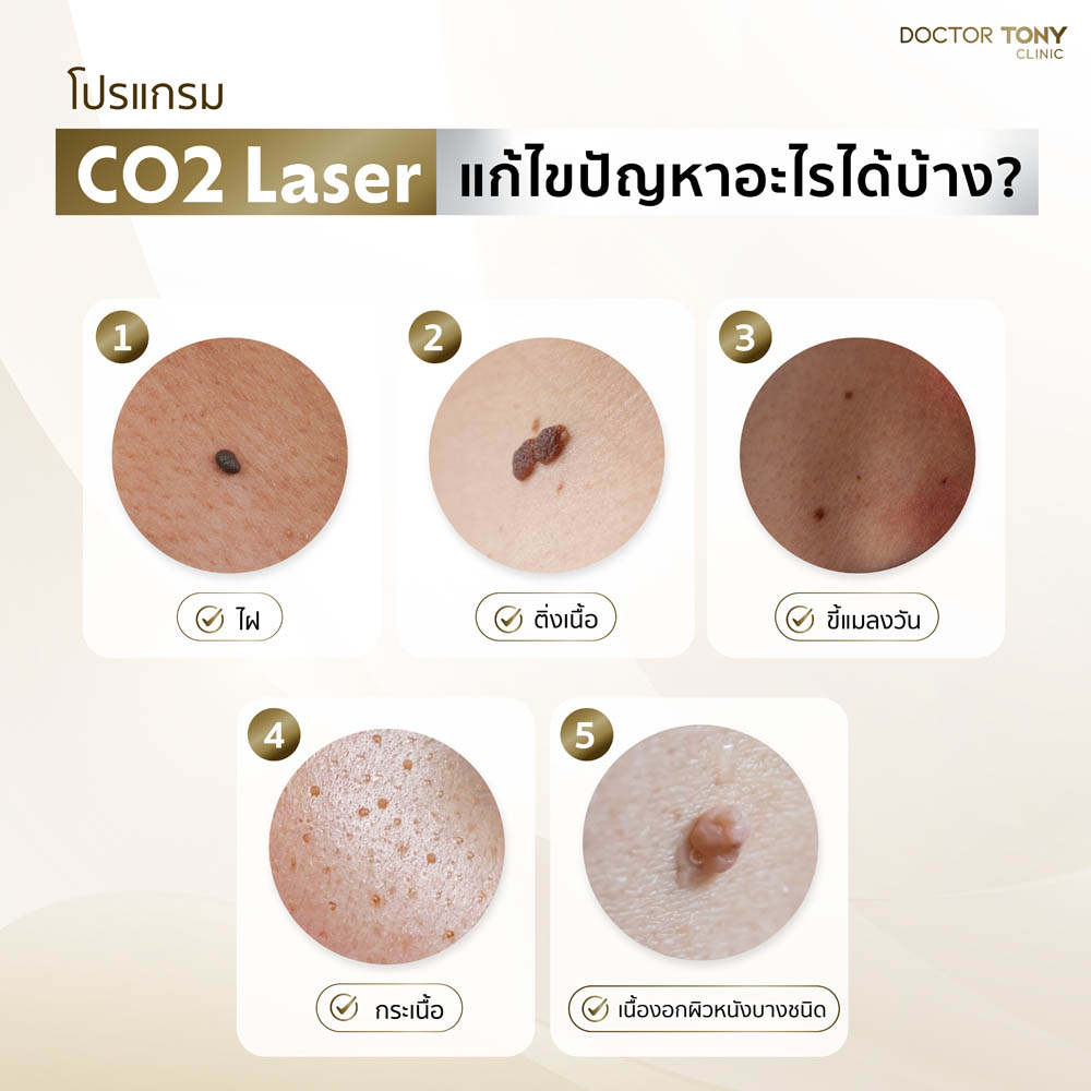 co2 laser ช่วยเรื่องอะไรบ้าง