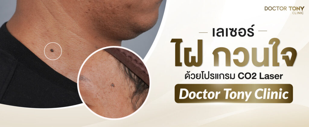 co2 laser กำจัดไฝ