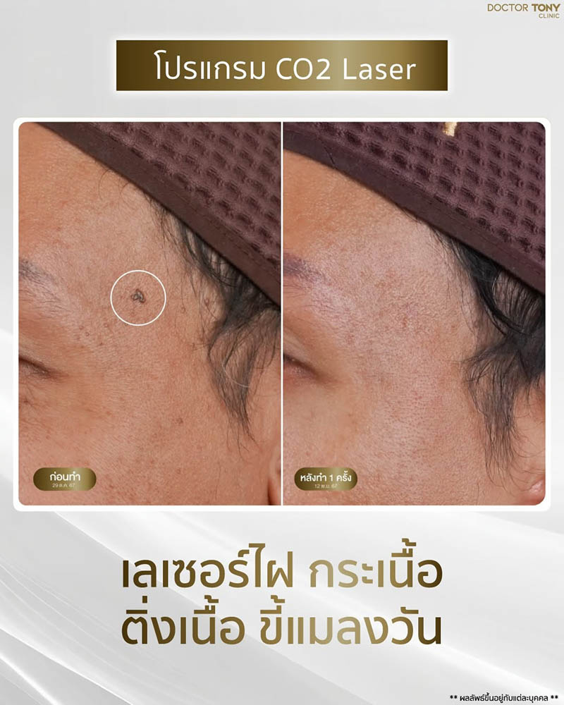รีวิว co2 เลเซอร์