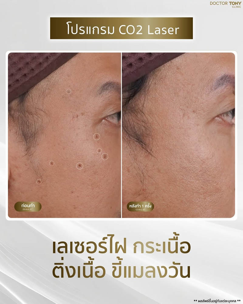รีวิว co2 เลเซอร์ 2