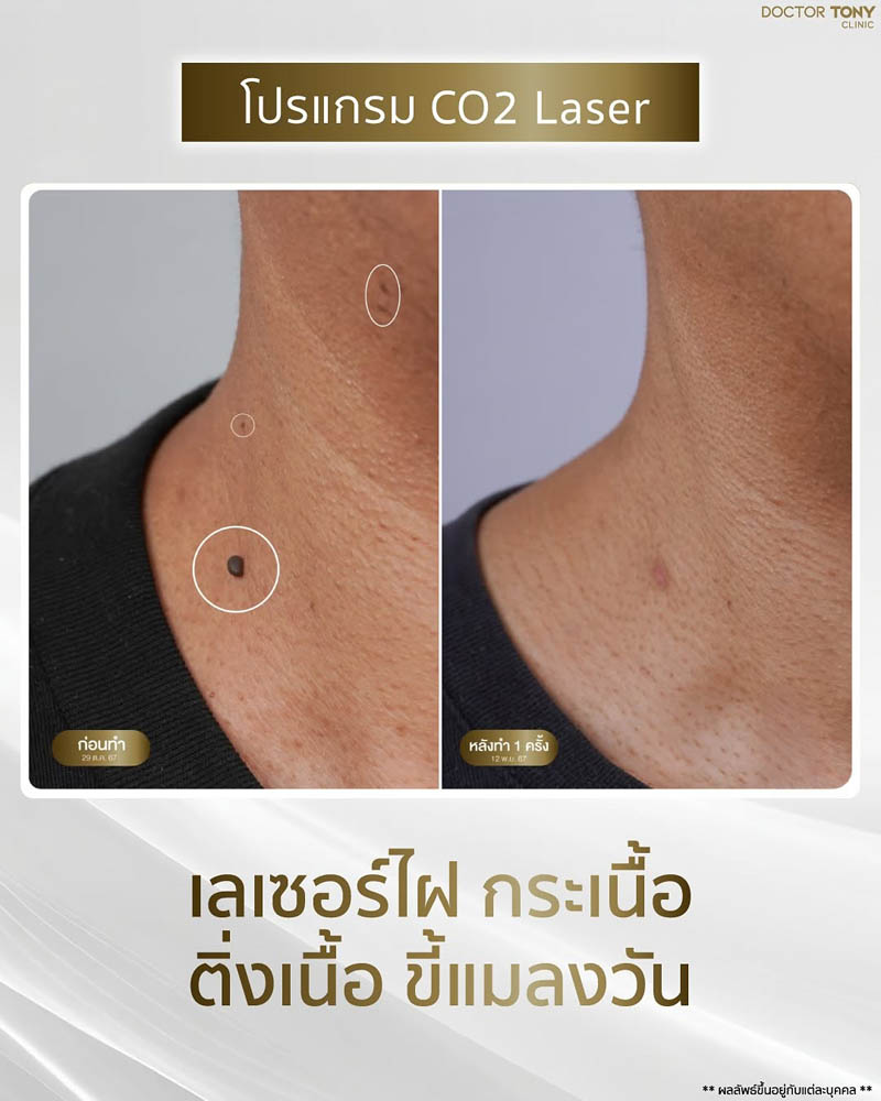 รีวิว co2 เลเซอร์ 3