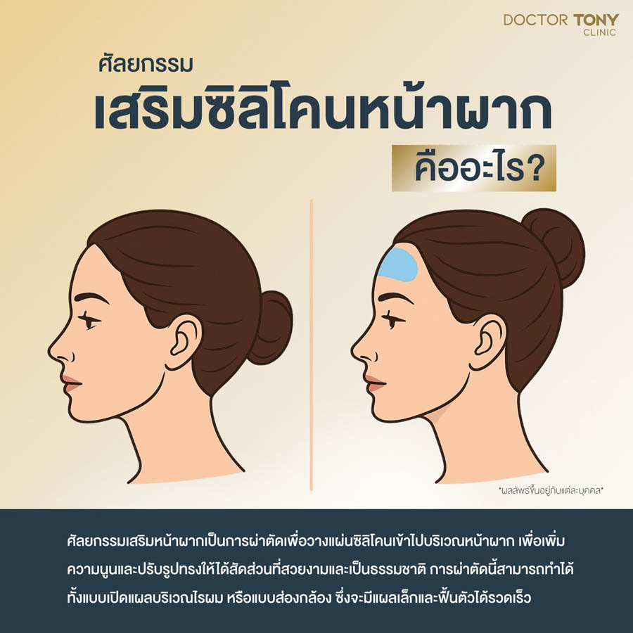เสริมหน้าผากคืออะไร