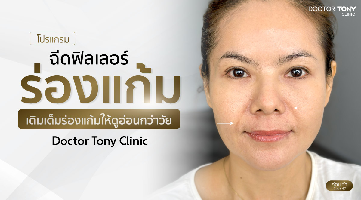 ฟิลเลอร์ร่องแก้ม