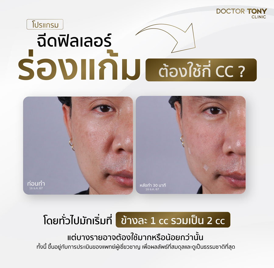ฉีดฟิลเลอร์ร่องแก้มต้องใช้กี่ CC