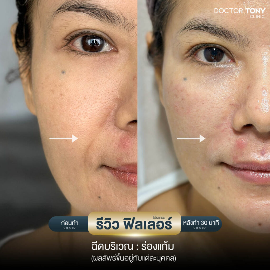 รีวิว ฟิลเลอร์ร่องแก้ม
