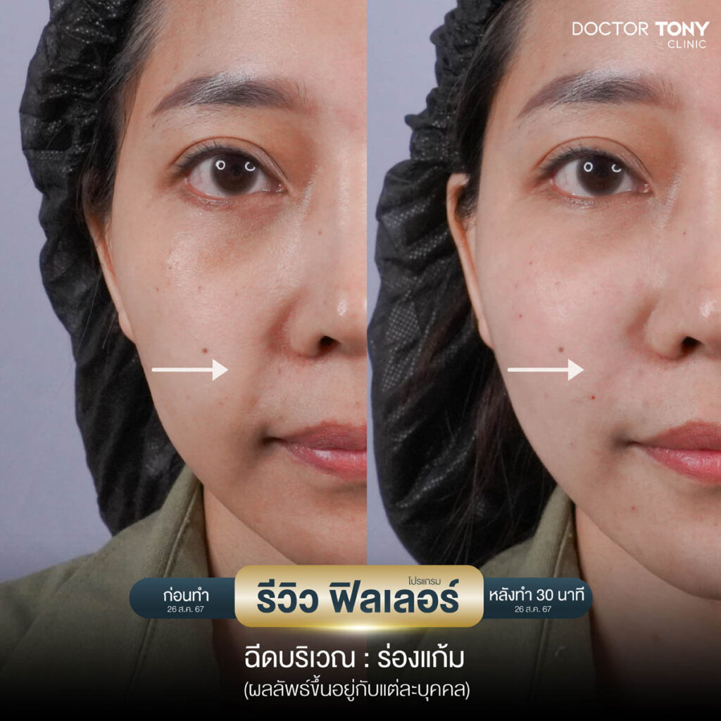 รีวิว ฟิลเลอร์ร่องแก้ม 6