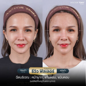 รีวิวฟิลเลอร์แก้มตอบ 3