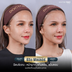 รีวิวฟิลเลอร์แก้มตอบ 1
