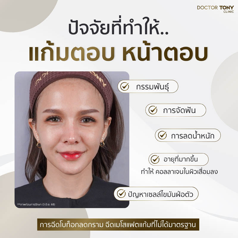 ฟิลเลอร์แก้มตอบ 1
